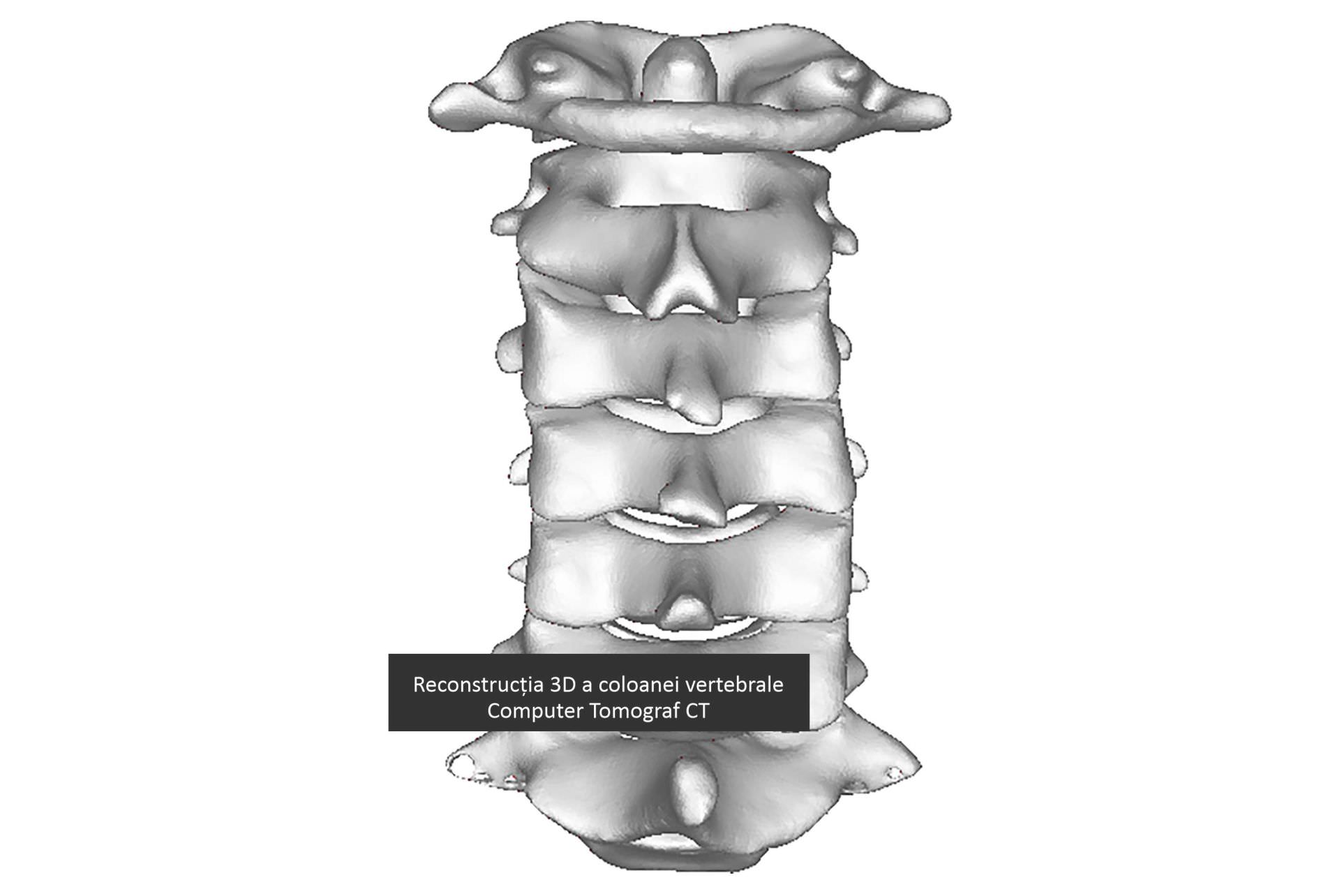 Reconstrucția 3D a coloanei vertebrale 2